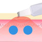 Face Blackhead Remover